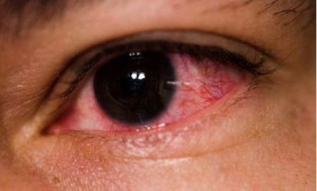 be-careful-now-madras-eye-is-coming