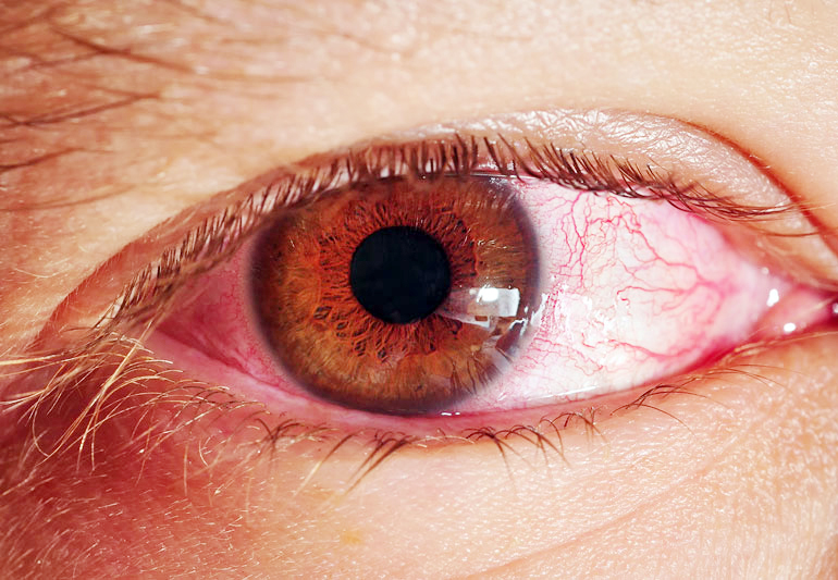 संसर्गजन्य ‘आय फ्लू’ची साथ EYE Flu