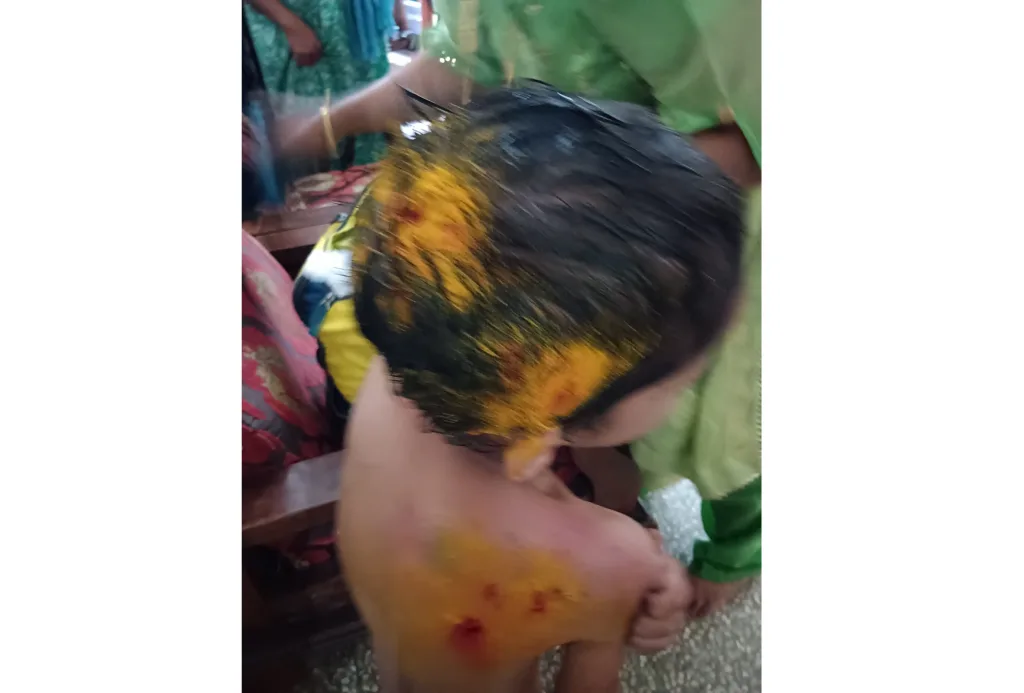 A child injured in an attack by stray dogs