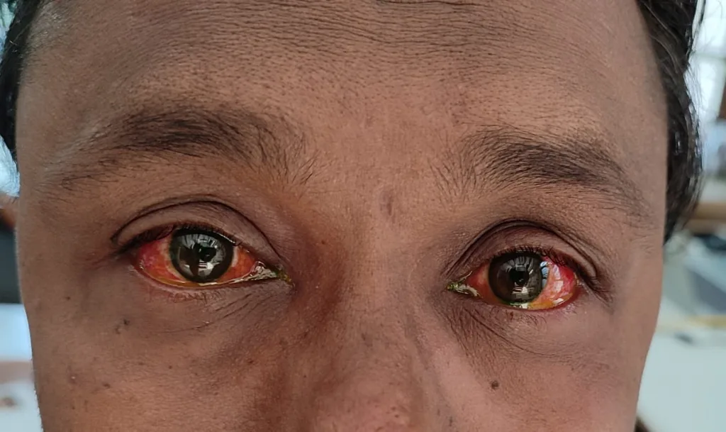 डोळ्याच्या संसर्गाबाबत दक्षता आवश्यक Caution is required for eye infections