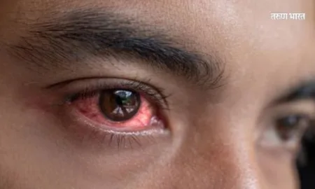 Conjunctivitis infection take care of your eyes ZP kolhapur