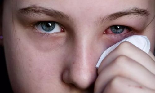 आय फ्लू पसरतोय, अशी घ्या डोळ्यांची काळजी I spread the flu, so take care of your eyes