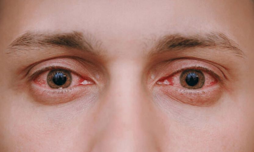 पिंपरी-चिंचवडमध्ये 5067 जणांना डोळ्यांच्या साथीचा प्रादुर्भाव; औषधाचाही तुटवडा 5067 cases of eye disease in Pimpri-Chinchwad