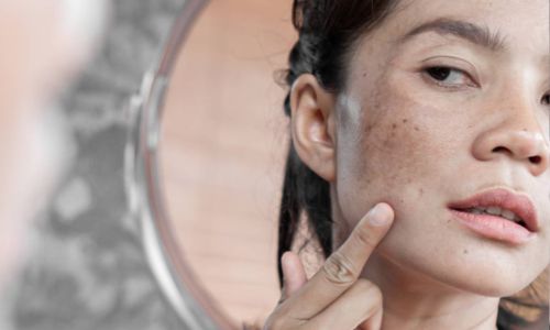चेहऱ्यावर काळे डाग आहेत? मग जाणून घ्या हे उपाय Do you have dark spots on your face? Then know these solutions
