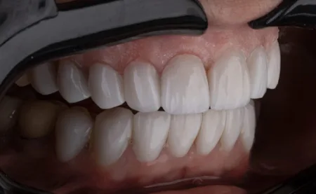 Now the teeth will sprout with medicine