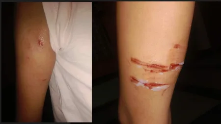 भयंकर! ९ वर्षाच्या लहान मुलीवर भटक्या कुत्र्यानी केला हल्ला