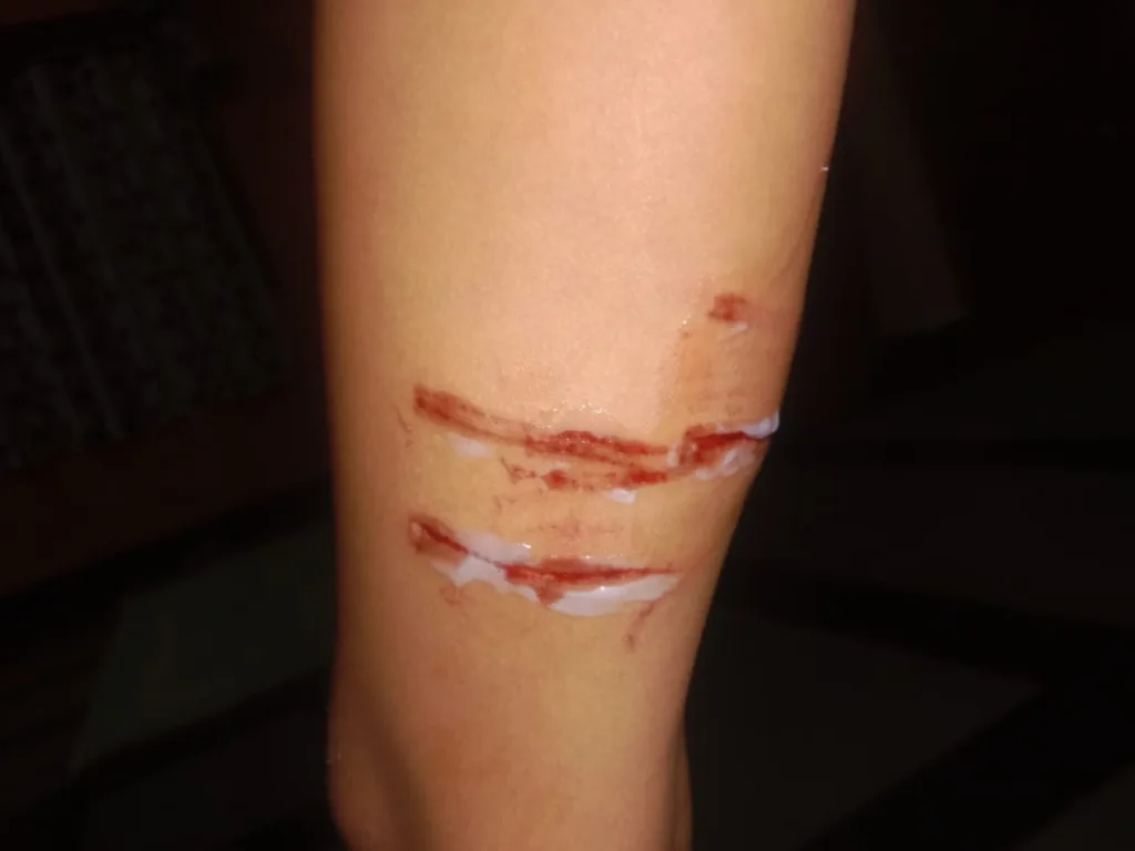 Girl attacked by stray dogs in Sadashivnagar