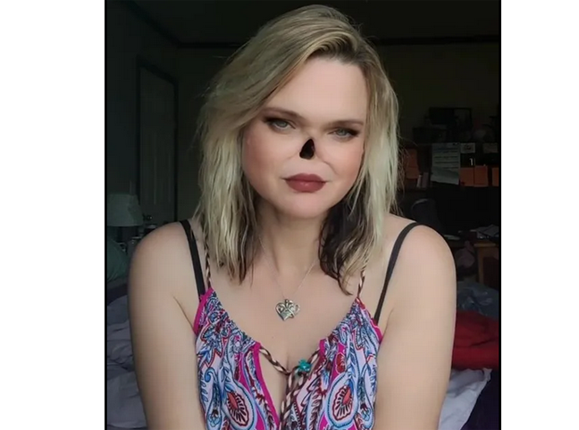 कापलेल्या नाकासोबत जगते महिला A woman lives with a cut nose