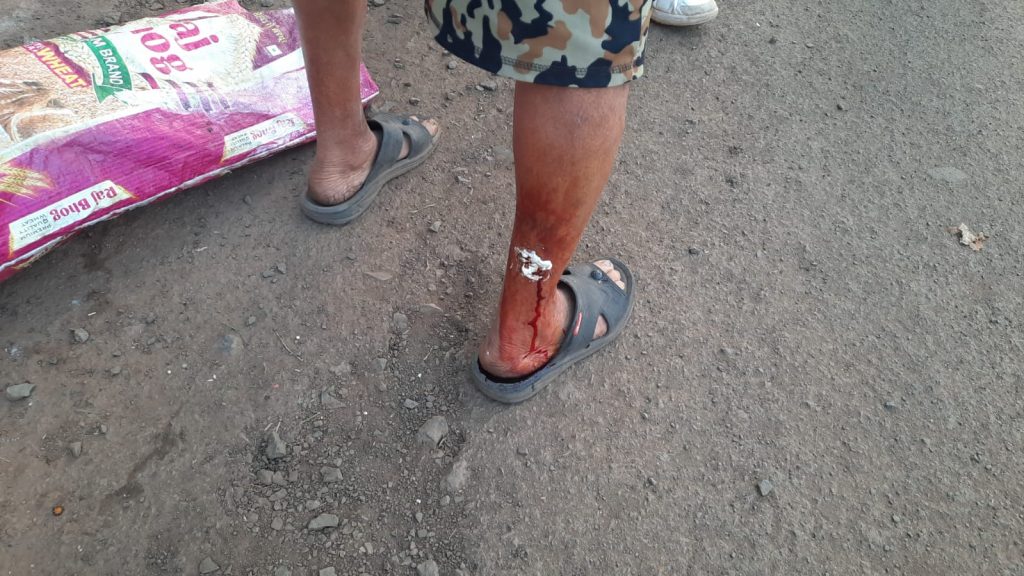 Stray dog attack in Bhagyanagar