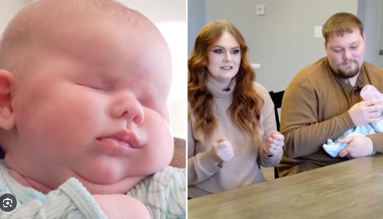 दुर्लभ आजारांमुळे डोळ्यांशिवाय जन्मली मुलगी Girl born without eyes due to rare diseases