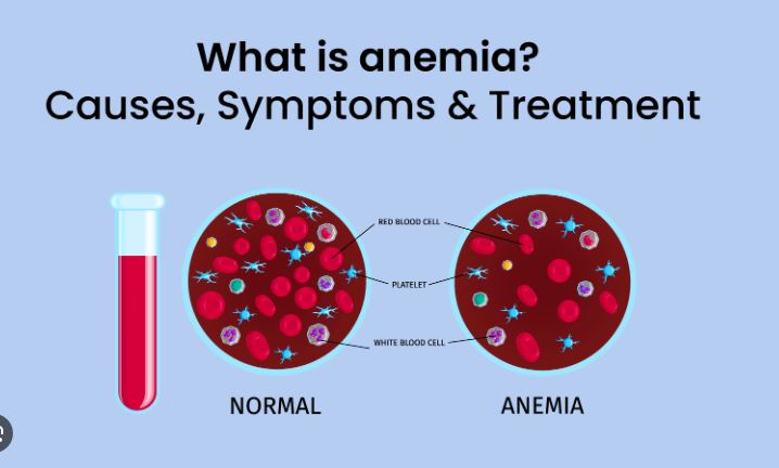 रक्तक्षयाचे सर्वात स्वस्त औषध भारतात ! The cheapest medicine for anemia in India!