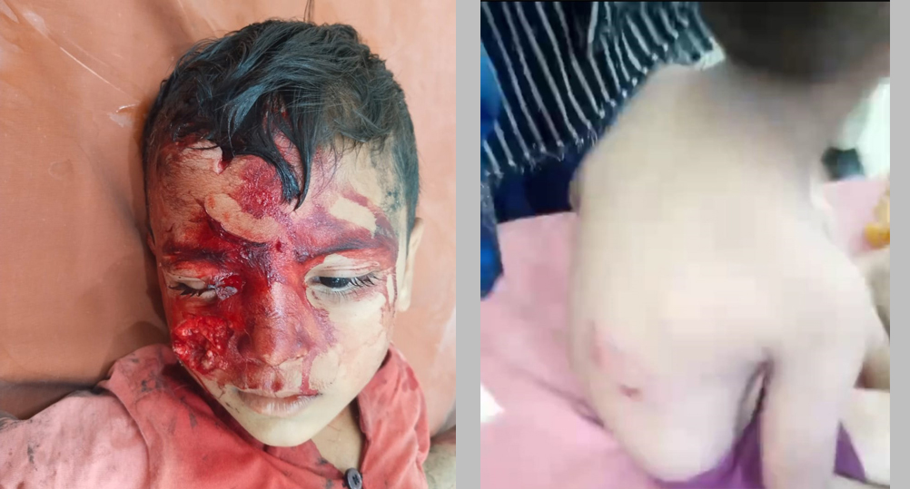 भटक्या कुत्र्याच्या हल्ल्यात दोन मुले जखमी